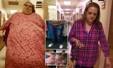 Woman who lost nearly 400LBS celebrates having 50lbs of excess skin surgically removed | Daily Mail Online