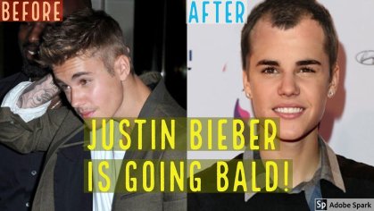 OMG JUSTIN BIEBER IS BALDING AND LOSING HAIR! - YouTube